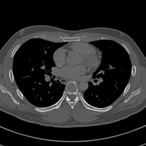 File:Apical lung mass mimic - neurogenic tumor (Radiopaedia 59918-67521 Axial bone window 43).jpg