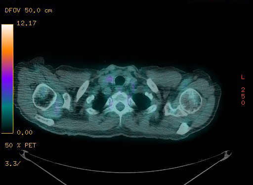 Appendiceal adenocarcinoma complicated by retroperitoneal abscess (Radiopaedia 58007-65041 Axial PET-CT 31).jpg