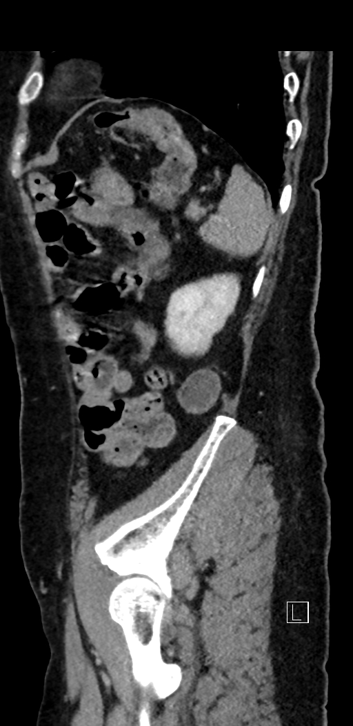 Appendiceal hemorrhage (Radiopaedia 70830-81025 Sagittal C+ delayed 88).jpg