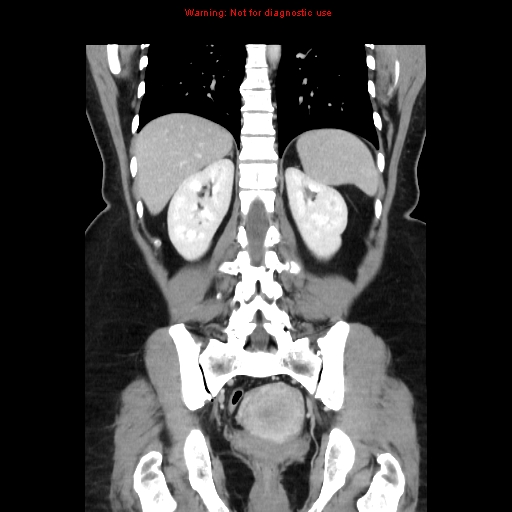 Appendiceal mucinous cystadenoma (Radiopaedia 8263-9111 B 53).jpg