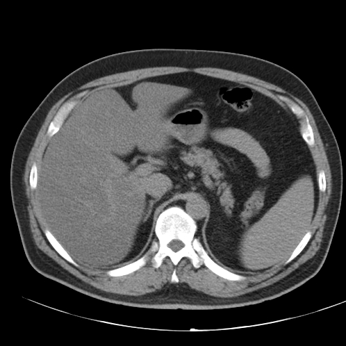 Appendicitis and giant appendicolith (Radiopaedia 80251-93588 Axial non-contrast 10).jpg