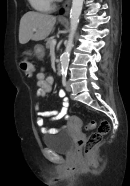 Appendicitis due to chicken fibula (Radiopaedia 74314-85198 C 53).jpg