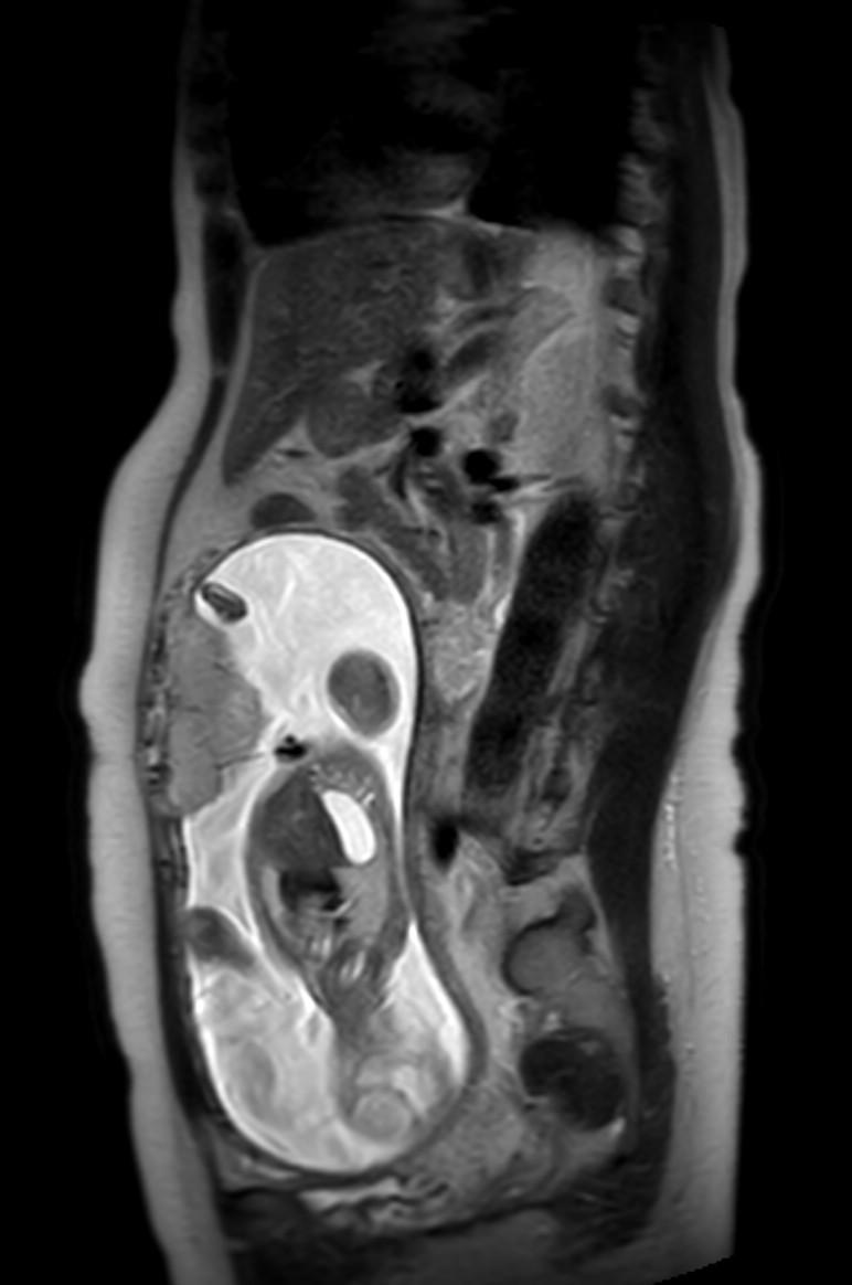 Appendicitis in gravida (MRI) (Radiopaedia 89433-106395 Sagittal T2 28).jpg