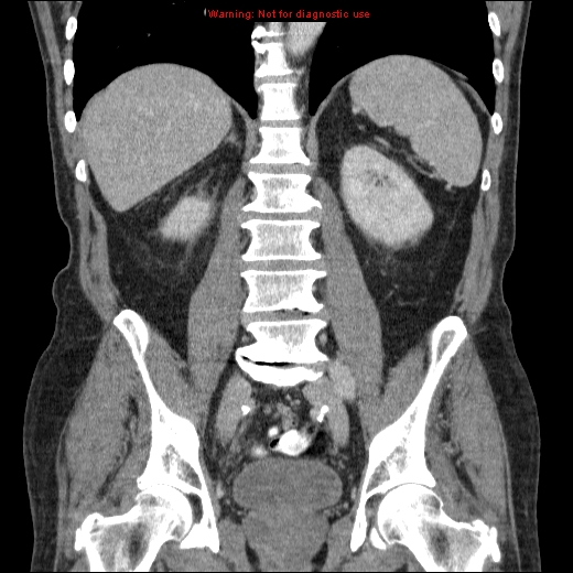 File:Appendicitis mass in inguinal hernia (Radiopaedia 26858-27029 B 50).jpg