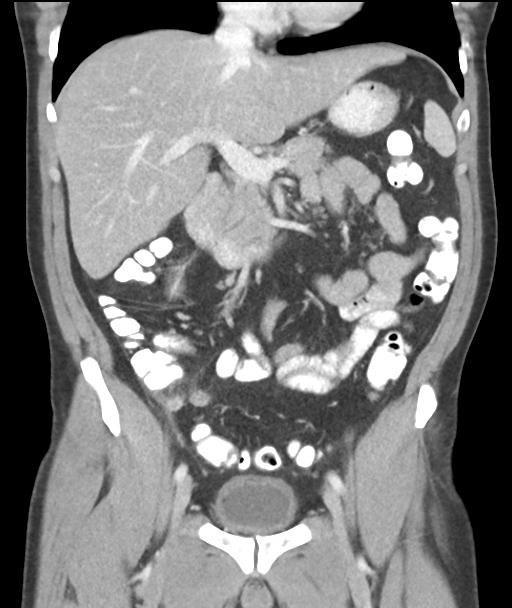 Appendicitis with cecal bar sign (Radiopaedia 31878-32830 A 29).jpg