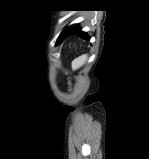 Appendicitis with localized perforation and abscess formation (Radiopaedia 49035-54130 C 61).jpg
