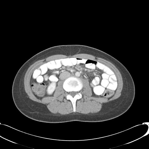 Appendicitis with minimal stranding but appendicolith (Radiopaedia 29035-29397 A 43).jpg
