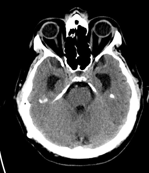 File:Aqueduct stenosis with corpus callosum hypoattenuation post shunting (Radiopaedia 37212-38973 Axial non-contrast 10).png