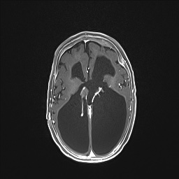 Aqueductal stenosis (Radiopaedia 73974-84802 Axial T1 C+ 87).jpg