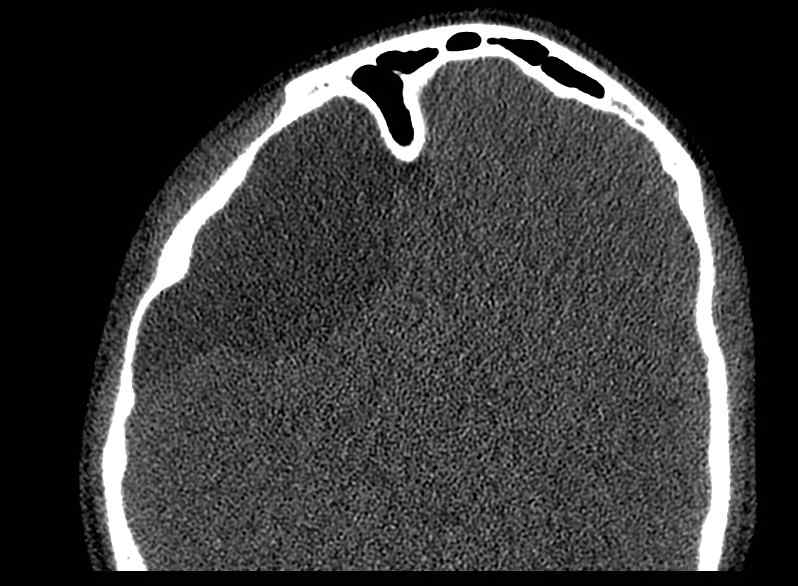 Arachnoid cyst- extremely large (Radiopaedia 68741-78450 Axial bone window 49).jpg