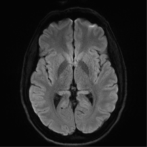 File:Arachnoid cyst - cerebellopontine angle (Radiopaedia 59689-67083 Axial DWI 54).png