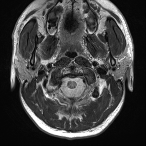 File:Arachnoid cyst - cerebellopontine angle (Radiopaedia 59689-67083 Axial T2 4).png