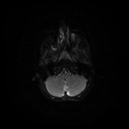 File:Arachnoid cyst - middle cranial fossa (Radiopaedia 86780-102938 Axial DWI 54).jpg