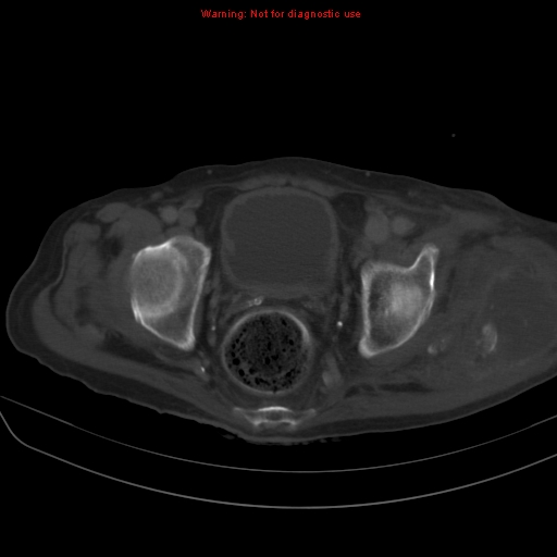 File:Arachnoiditis ossificans (Radiopaedia 51394-57136 Axial bone window 41).jpg