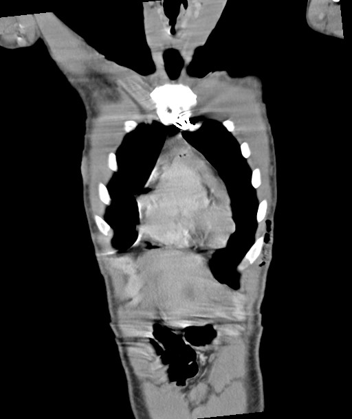 Arrow injury to the chest (Radiopaedia 85367-100975 F 45).jpg