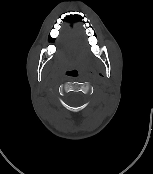Arrow injury to the face (Radiopaedia 73267-84011 Axial bone window 31).jpg