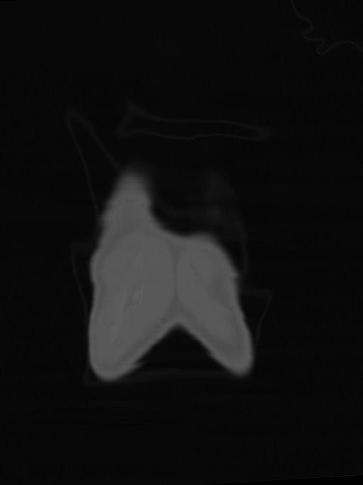 Arrow injury to the neck (Radiopaedia 75225-86323 Coronal bone window 7).jpg