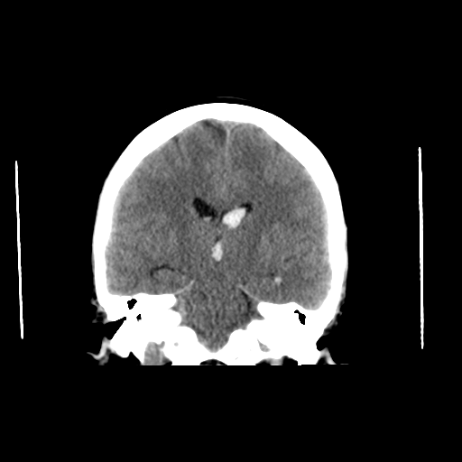 File:Arteriovenous malformation (cerebral) (Radiopaedia 40070-42579 Axial non-contrast 1).png