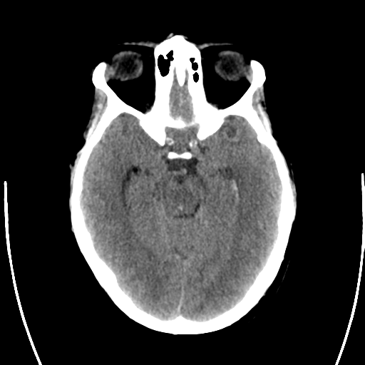 File:Arteriovenous malformation (cerebral) (Radiopaedia 40070-42579 Axial non-contrast 13).png