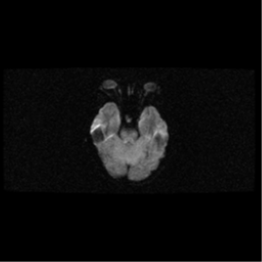 File:Arteriovenous malformation (cerebral) (Radiopaedia 40070-42580 Axial DWI 8).png