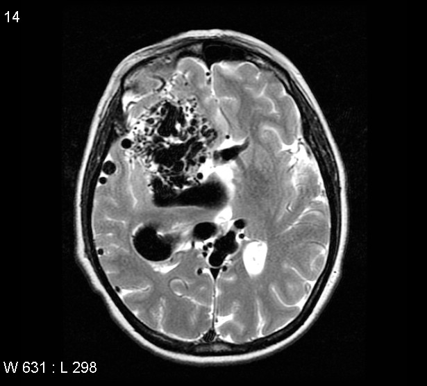 File:Arteriovenous malformation - cerebral (Radiopaedia 4000-6538 Axial T2 8).jpg