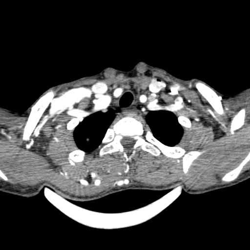 Arteriovenous malformation of the neck (Radiopaedia 53935-60062 A 1).jpg