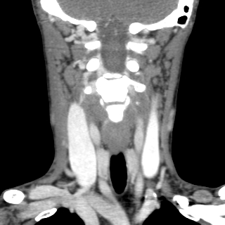 File:Arteriovenous malformation of the neck (Radiopaedia 53935-60062 D 1).jpg