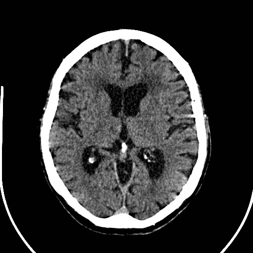 File:Artery of Percheron infarction (Radiopaedia 26307-26438 Axial non-contrast 20).jpg