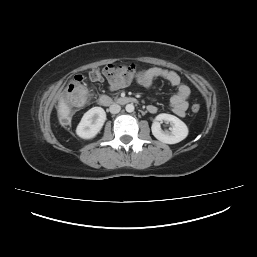 Ascending retrocecal appendicitis with liver abscesses (Radiopaedia 60066-67615 B 44).jpg