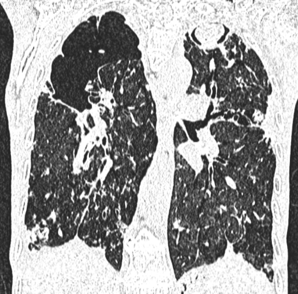Aspergilloma- with Monod sign (Radiopaedia 44737-48532 Coronal lung window 287).jpg
