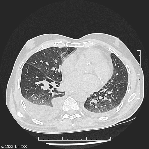 Aspergilloma (Radiopaedia 75184-86270 Axial lung window 31).jpg