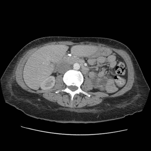 File:Aspiration pneumonia secondary to laparoscopic banding (Radiopaedia 18345-18183 A 68).jpg