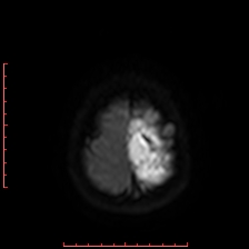 Astroblastoma (Radiopaedia 74287-85162 Axial DWI 101).jpg