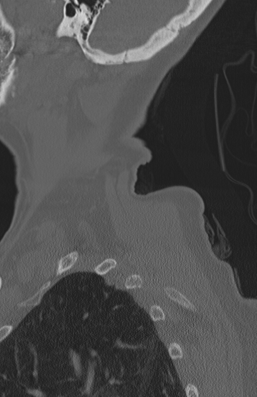 Atlanto-axial subluxation (Radiopaedia 36610-38176 Sagittal bone window 11).png