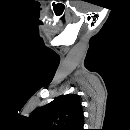 Atlanto-occipital dissociation (Traynelis type 1), C2 teardrop fracture, C6-7 facet joint dislocation (Radiopaedia 87655-104061 D 18).jpg