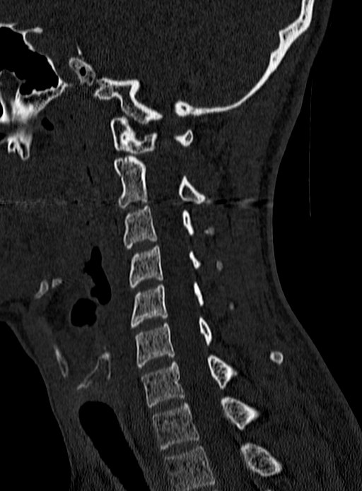 Atlantoaxial subluxation (Radiopaedia 44681-48450 Sagittal bone window 96).jpg