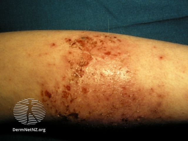 File:Atopic dermatitis (DermNet NZ dermatitis-flexural-eczema16).jpg