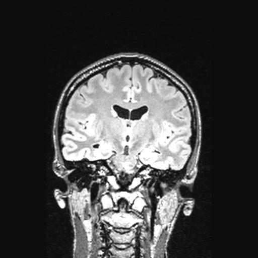 Atretic encephalocoele with inferior vermis hypoplasia (Radiopaedia 30443-31108 Coronal FLAIR 95).jpg