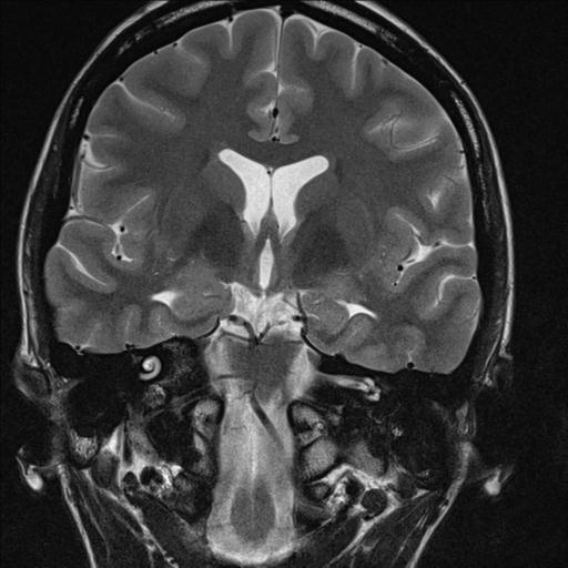 File:Atretic encephalocoele with inferior vermis hypoplasia (Radiopaedia 30443-31108 Coronal T2 9).jpg