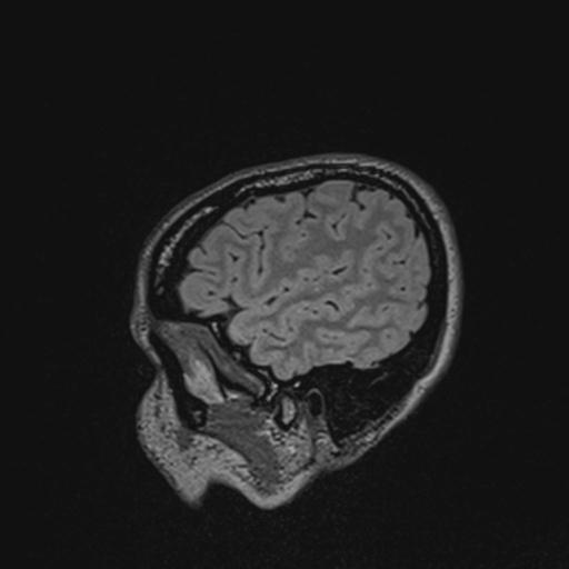 Atretic encephalocoele with inferior vermis hypoplasia (Radiopaedia 30443-31108 Sagittal FLAIR 34).jpg