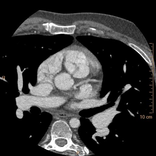 Atrial septal defect (upper sinus venosus type) with partial anomalous pulmonary venous return into superior vena cava (Radiopaedia 73228-83961 A 90).jpg