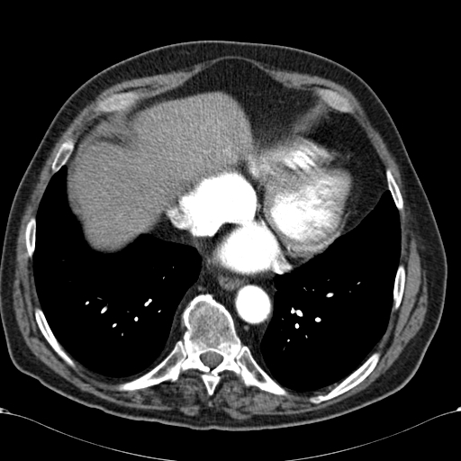 Atypical hepatocellular carcinoma (Radiopaedia 41744-44698 A 7).jpg