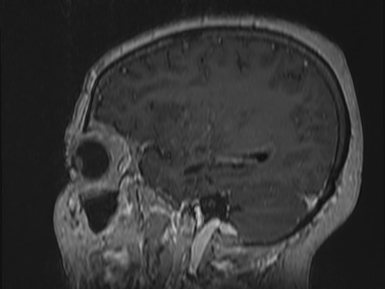 Atypical meningioma (Radiopaedia 62985-71406 Sagittal T1 C+ 20).jpg