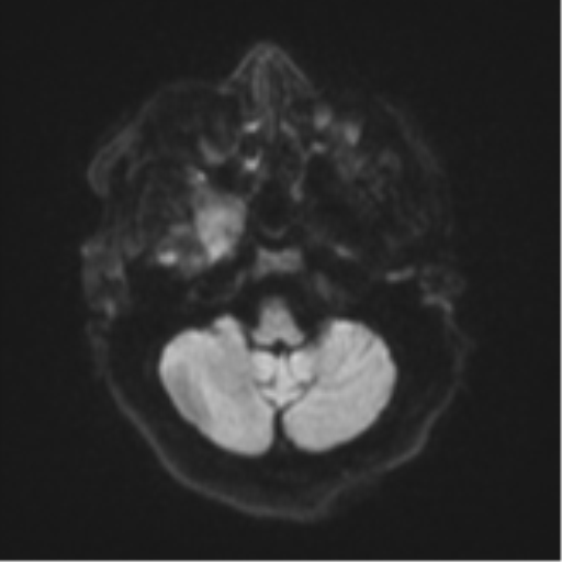 Atypical meningioma (WHO Grade II) (Radiopaedia 54742-60981 Axial DWI 34).png