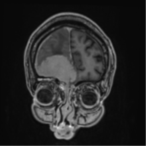 File:Atypical meningioma (WHO grade II) with brain invasion (Radiopaedia 57767-64729 Coronal T1 C+ 11).png