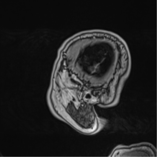 Atypical meningioma (WHO grade II) with brain invasion (Radiopaedia 57767-64729 Sagittal T1 C+ 12).png