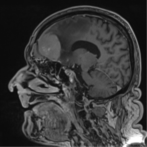 File:Atypical meningioma (WHO grade II) with brain invasion (Radiopaedia 57767-64729 Sagittal T1 C+ 40).png