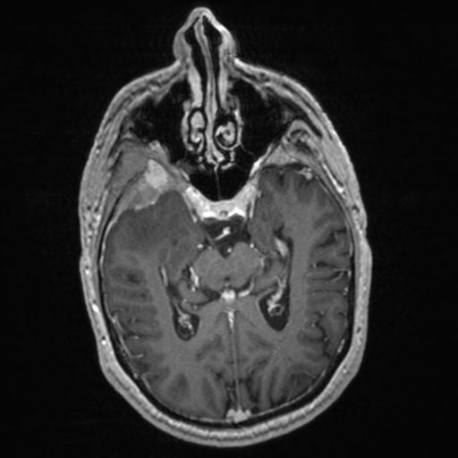 Atypical meningioma (grade II) - en plaque (Radiopaedia 29633-30147 Axial T1 C+ 82).jpg