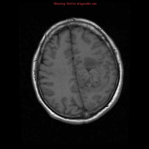 File:Atypical meningioma - grade II (Radiopaedia 13303-13305 Axial T1 16).jpg