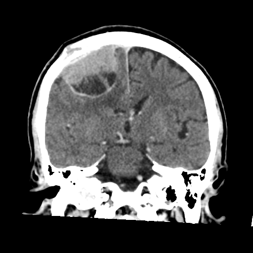 Atypical meningioma with skull invasion (Radiopaedia 34357-35649 Coronal C+ delayed 32).png